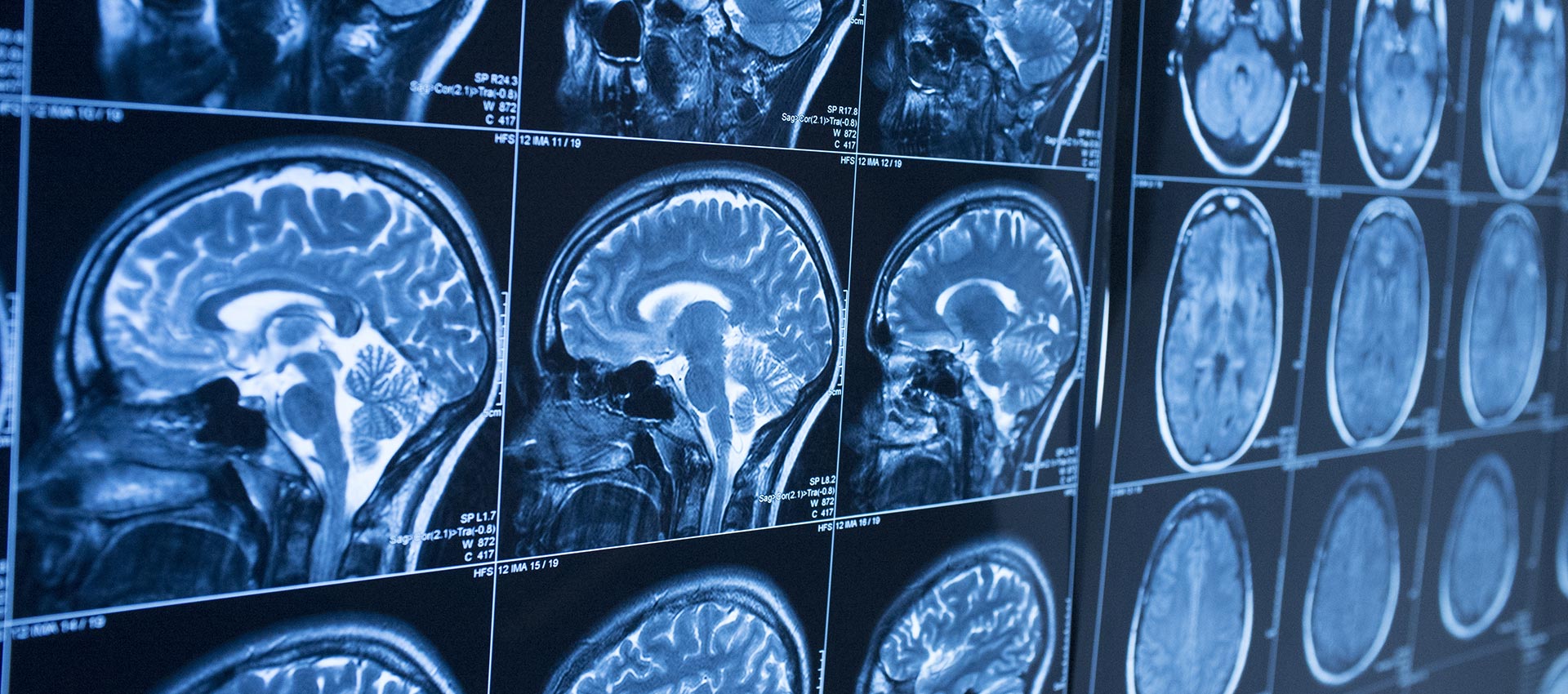 Magnetic Resonance Imaging (MRI)